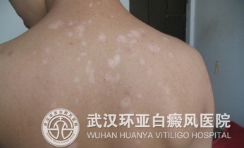 常见的白癜风症状有哪些
