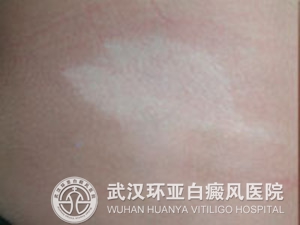 白癜风的护理有哪些重要事项