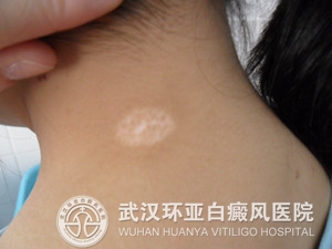 白癜风怎么进行自我心理疗法