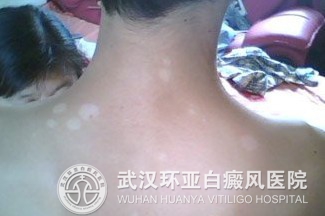 白癜风日常保健办法是什么