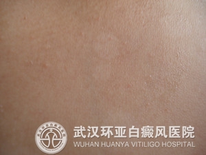 治疗白癜风要注意什么细节