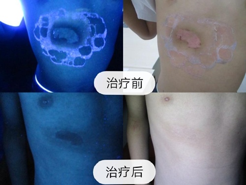 北京高级专家公益门诊暨白癜风公益大筛查