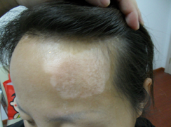 武汉白癜风医院提示女性患上白癜风的症状都有哪些